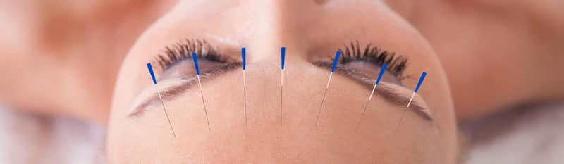 Does Acupuncture Hurt?