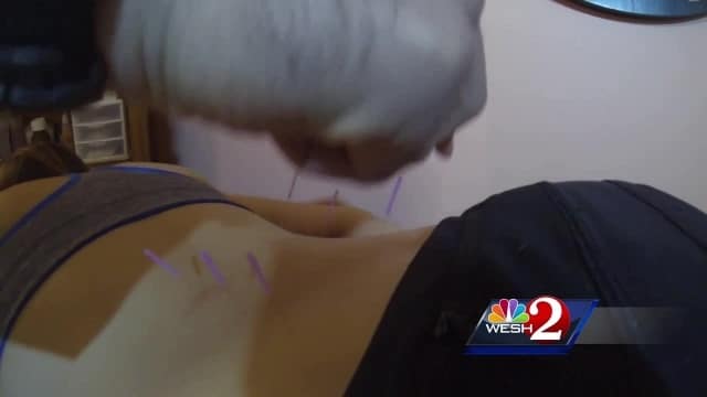 Acupuncture used to treat addiction